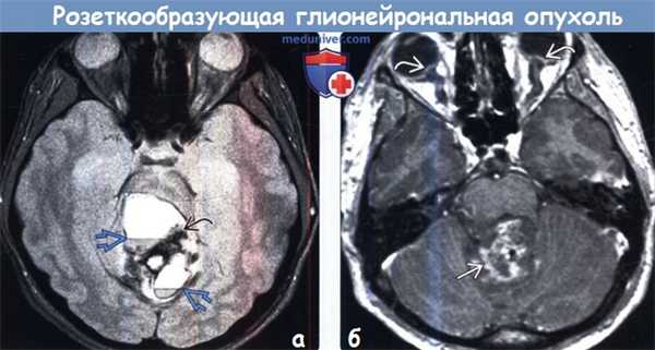 Розеткообразующая глионейрональная опухоль (РГНО) на МРТ