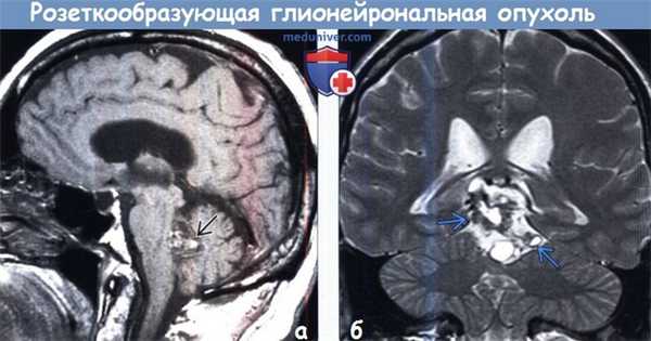 Розеткообразующая глионейрональная опухоль (РГНО) на МРТ