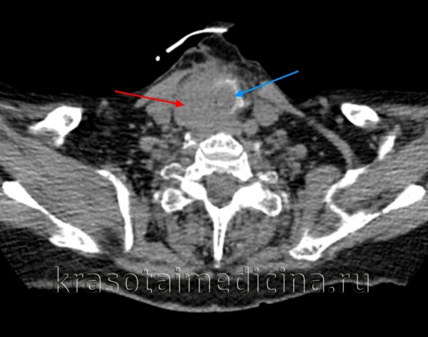 КТ шеи. Инвазивная опухоль щитовидной железы (красная стрелка) с прорастанием в трахею (синяя стрелка).