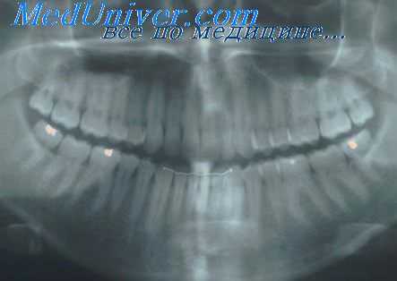 стадии пародонтита