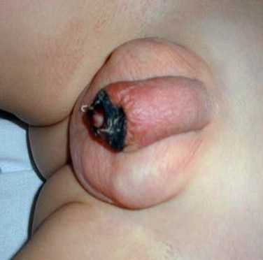 Некроз головки полового члена