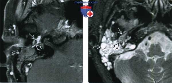 КТ, МРТ при гломусной тимпанической параганглиоме