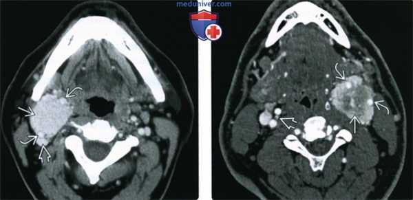 КТ, МРТ, УЗИ при каротидной параганглиоме