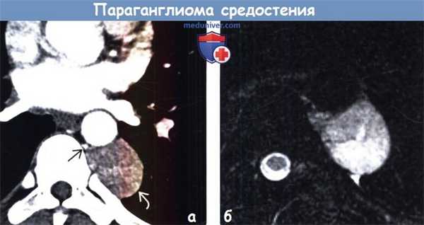 Параганглиома средостения на КТ, МРТ