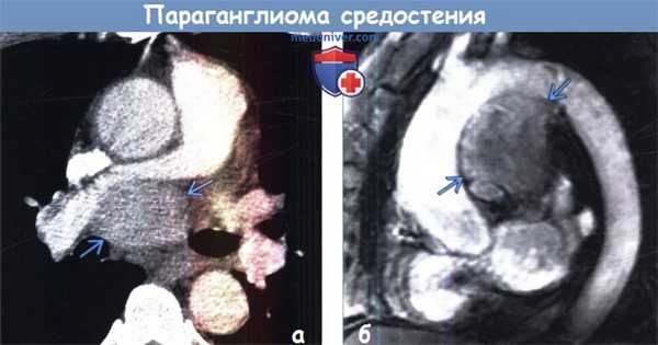 Параганглиома средостения на КТ, МРТ