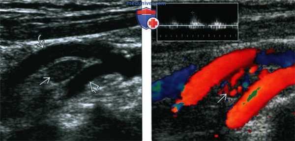 КТ, МРТ, УЗИ при каротидной параганглиоме