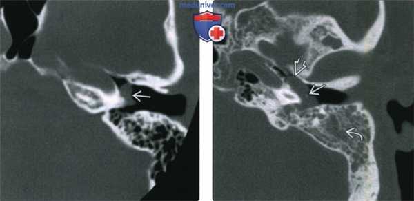 КТ, МРТ при гломусной тимпанической параганглиоме