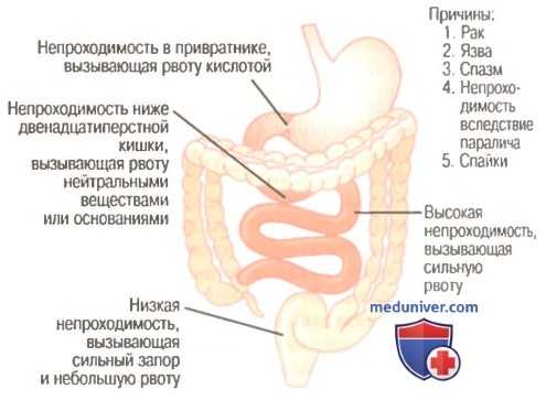 Желудочно-кишечная непроходимость