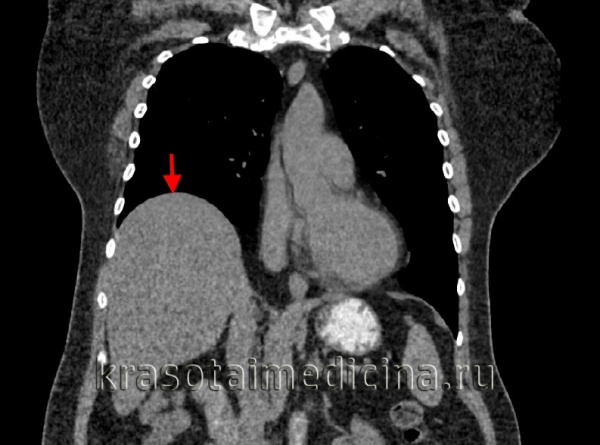 КТ органов грудной клетки. Релаксация, высокое положение правого купола диафрагмы