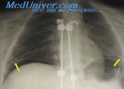 искусственный пневмоторакс