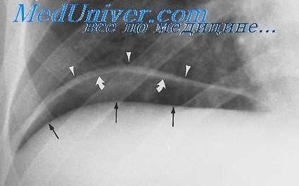 паралич диафрагмы