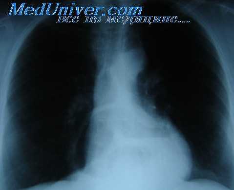 паралич диафрагмы