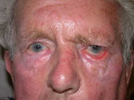 Отхождение слезоотделительных волокон