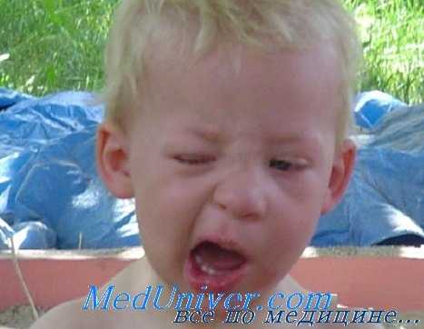 Паралич Белла у ребенка