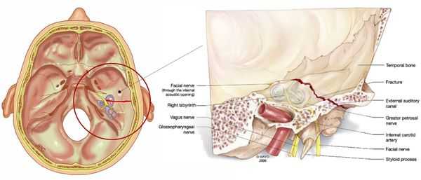 Перелом пирамиды височной кости