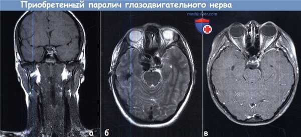 Приобретенный паралич глазодвигательного нерва