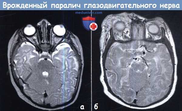 Врожденный паралич глазодвигательного нерва (3 пары ЧМН)