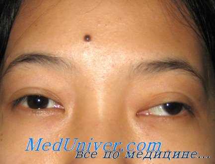 паралич черепных нервов у детей