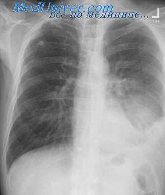 инфицирование плевральной полости