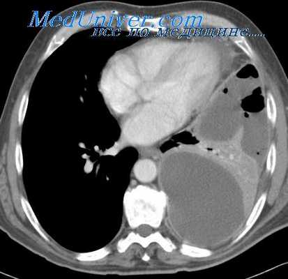 анестезия в торакальной хирургии