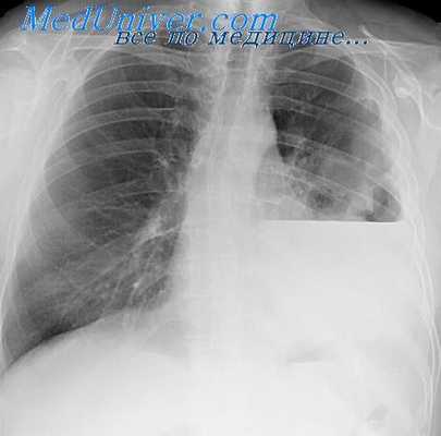 торакальные больные