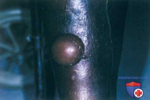 Буллезные высыпания