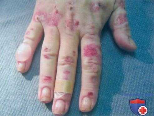 Поздняя кожная порфирия