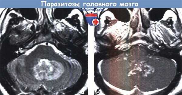 Паразитозы головного мозга на МРТ
