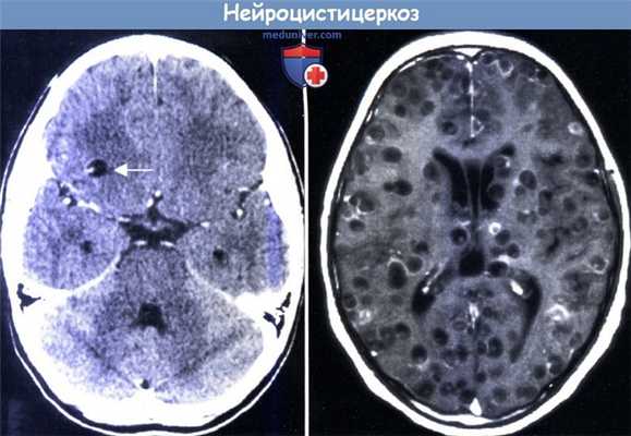 Нейроцистицеркоз