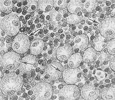 Рис. 1. Микропрепарат селезенки при болезни Гоше: видны округлые клетки Гоше (указаны стрелками).