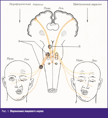Поражения лицевого нерва
