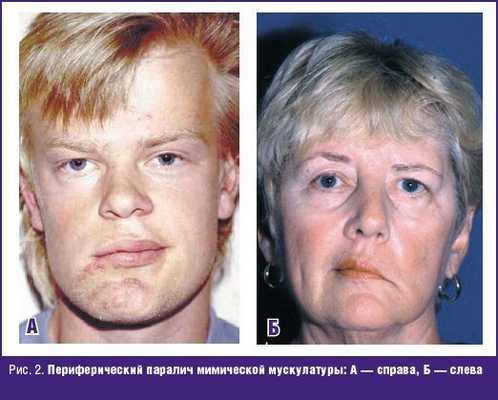Периферический паралич мимической мускулатуры