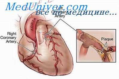 коронарный кровоток при алкоголизме