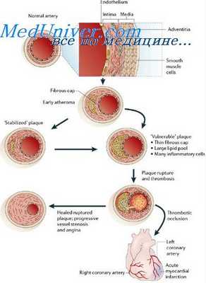 алкогольный атеросклероз