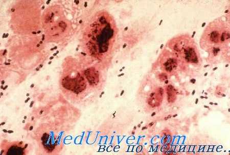 бактериальный менингит у детей