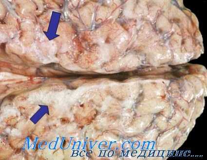 морфология менингита у детей