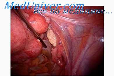 опухоли яичников