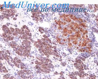 новообразования стромы яичников