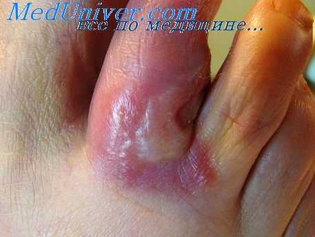 колорадская лихорадка