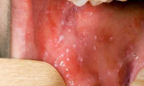 Пятна Бельского — Филатова — Коплика