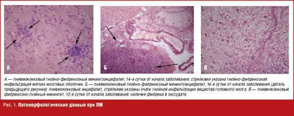 Патоморфологические данные при ПМ