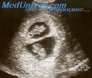 синдром фето-фетальной трансфузии