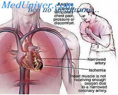 патогенез стенокардии