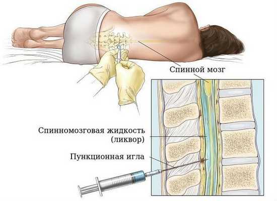 Люмбальная пункция