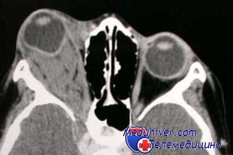 бактерии в средах глаза