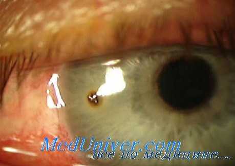 инфекции в глазе