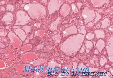 острый гнойный тиреодит