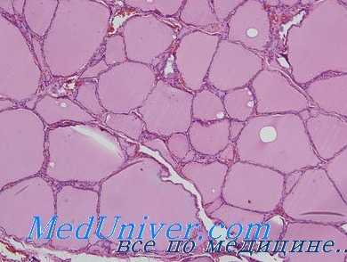 тиреодити риделя