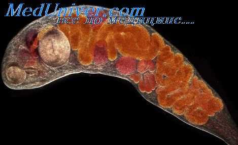 парагонимоз