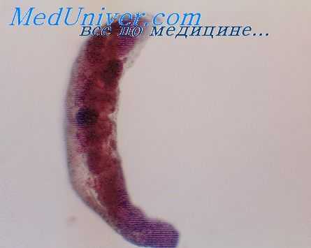 парагонимоз